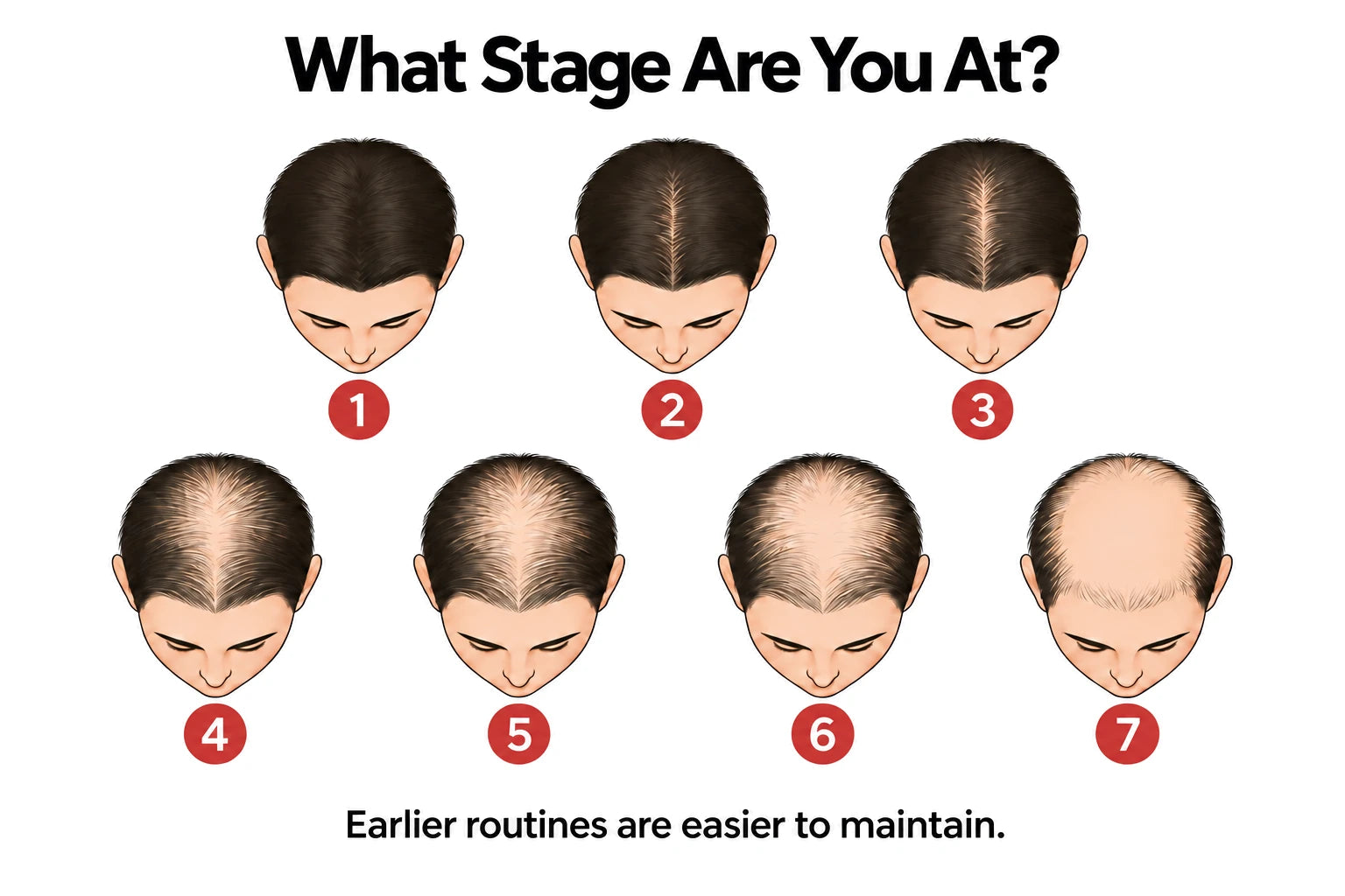 Simplified guide showing seven stages of progressive hair thinning