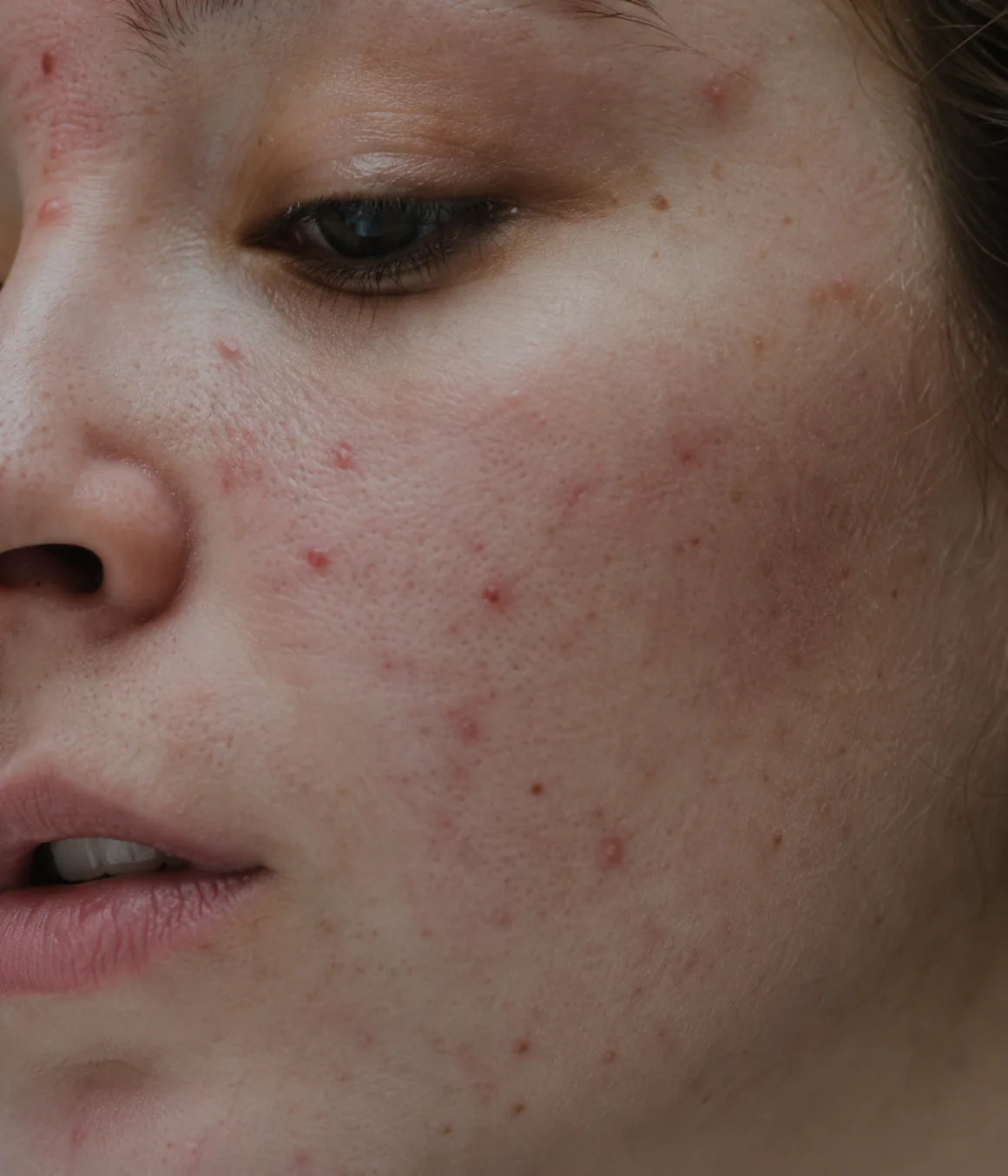 Close-up of natural skin texture with a few small blemishes